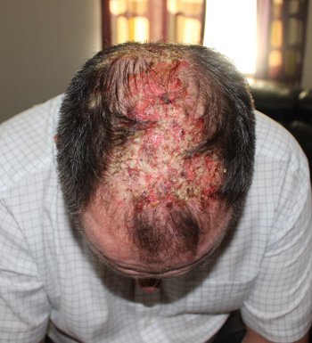 fundraising skin condition-f
